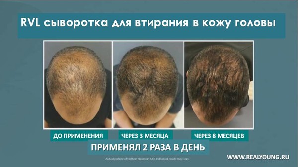 Сейчас облысение лечат в основном с помощью миноксидила, который способствует увеличению количества кровеносных сосудов в коже головы и различных анти-андрогенов – веществ, снижающих количество мужских половых гормонов (в частности, тестостерона). 

Ещё один вариант – пересадка волос. Однако все эти способы растянуты во времени и в среднем позволяют воссоздать 30 волос на один квадратный сантиметр головы, в то время как на здоровой коже на той же площади растёт несколько сотен волос. 

Команда учёных еще в 2017 году под руководством Джорджа Котсарелиса (George Cotsarelis) из школы медицины университета Пенсильвании (School of Medicine) опубликовала в престижном журнале Nature статью об открытии: клетки кожи головы человека могут воссоздавать погибшие волосяные луковицы. 

Ранее факт подобного восстановления отмечался у мышей, кроликов и даже людей. Но никто из учёных не мог предположить, что это не частные случаи, а тенденция, и тем более никто не исследовал этот факт подробно. 

Американские учёные обнаружили, что когда кожа головы каким-либо образом ранена, клетки эпидермиса перенимают свойства стволовых клеток, в них появляются волосяные луковицы и вырастают новые волосы. 

Для изучения этого механизма исследователи взяли образцы ткани раневой поверхности у мышей и наблюдали за ними в течение нескольких недель. 

Оказалось, что в процессе залечивания ткани некоторые клетки, не связанные с волосяным покровом, включают гены, которые обычно работают в стволовых клетках, и в коже появляются новые волосяные луковицы. Из них растут новые волосы. Проблема только одна: они не содержат пигменты. 

Скорость восстановления не зависела от возраста мыши. Таким образом, если подобное явление будет подтверждено у людей (а учёные уверены, что произойдёт это совсем скоро), то даже старики смогут восстановить свою когда-то пышную шевелюру. 

Этот опыт стал ещё одним подтверждением способностей к регенерации у млекопитающих, когда-то приписываемой всяческим саламандрам с тритонами. 

Чтобы кожа после ранения (процедура похожа на механическую чистку лица различными абразивными средствами) не просто залечивалась, но и восстанавливался волосяной покров, учёные использовали специальный белок wnt, который усилил экспрессию нужных генов. Как следствие, образовалось больше волосяных луковиц. 

Если же блокировать действие белка, то в новой коже не будет ни одного волоса. 

В новой усовершенствованной системе доктора Натана Ньюмена это уже все учтено. Плюс собственные наработки позволили создать RVL - REVEAL (РЕВИЛ) - УСОВЕРШЕНСТВОВАННАЯ СИСТЕМА ДЛЯ КОЖИ ГОЛОВЫ . 

Заходите на сайт узнать подробнее - http://j.mp/OneReVeaL 

Ставьте Лайки, жмите Поделиться и пишите комментарии